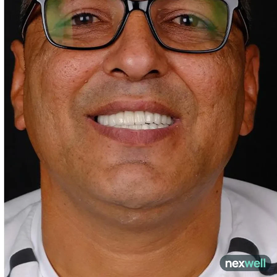 After: full mouth All-on-6 implant restoration, 2022
