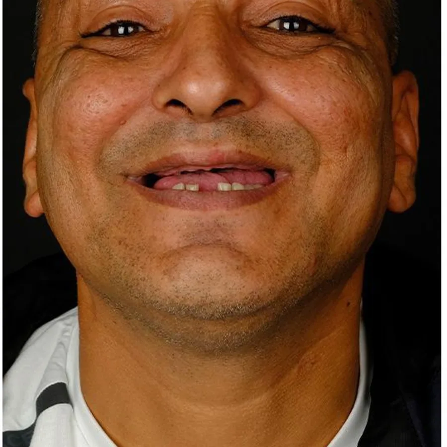 Before: full mouth All-on-6 implant restoration, 2022