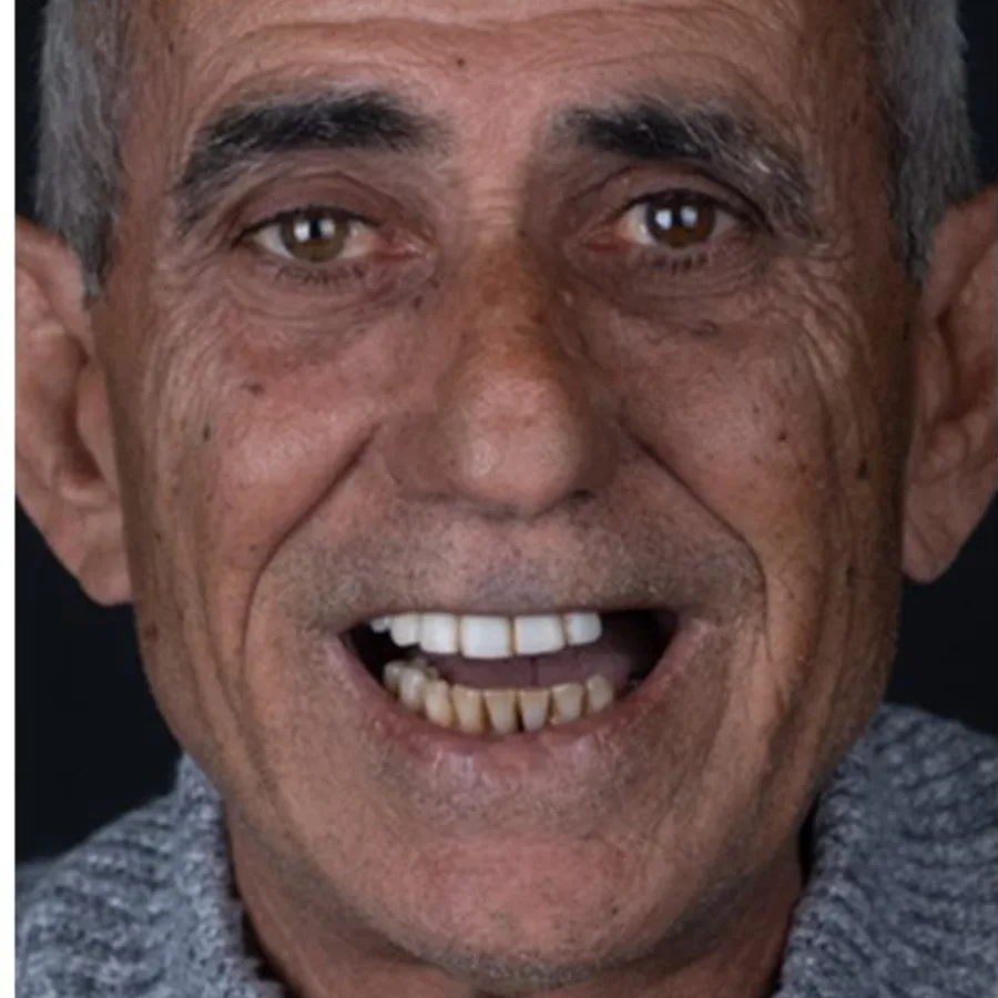 Before: full mouth All-on-6 implant restoration, 2023