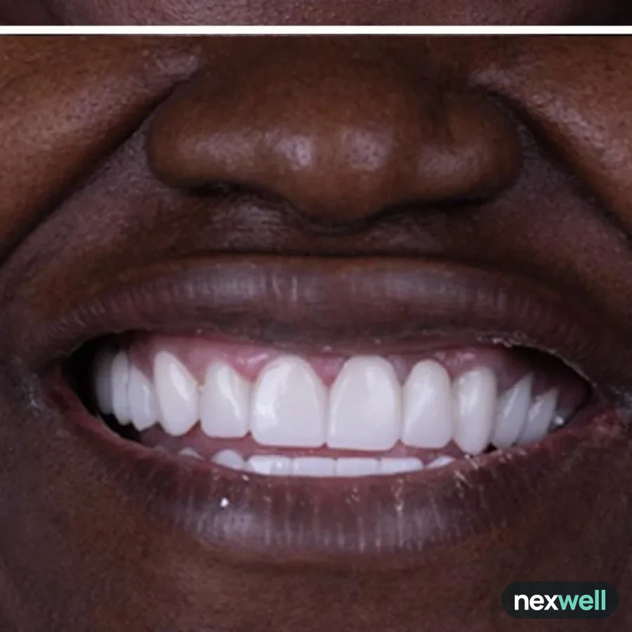 After: full mouth All-on-6 implant restoration, 2024