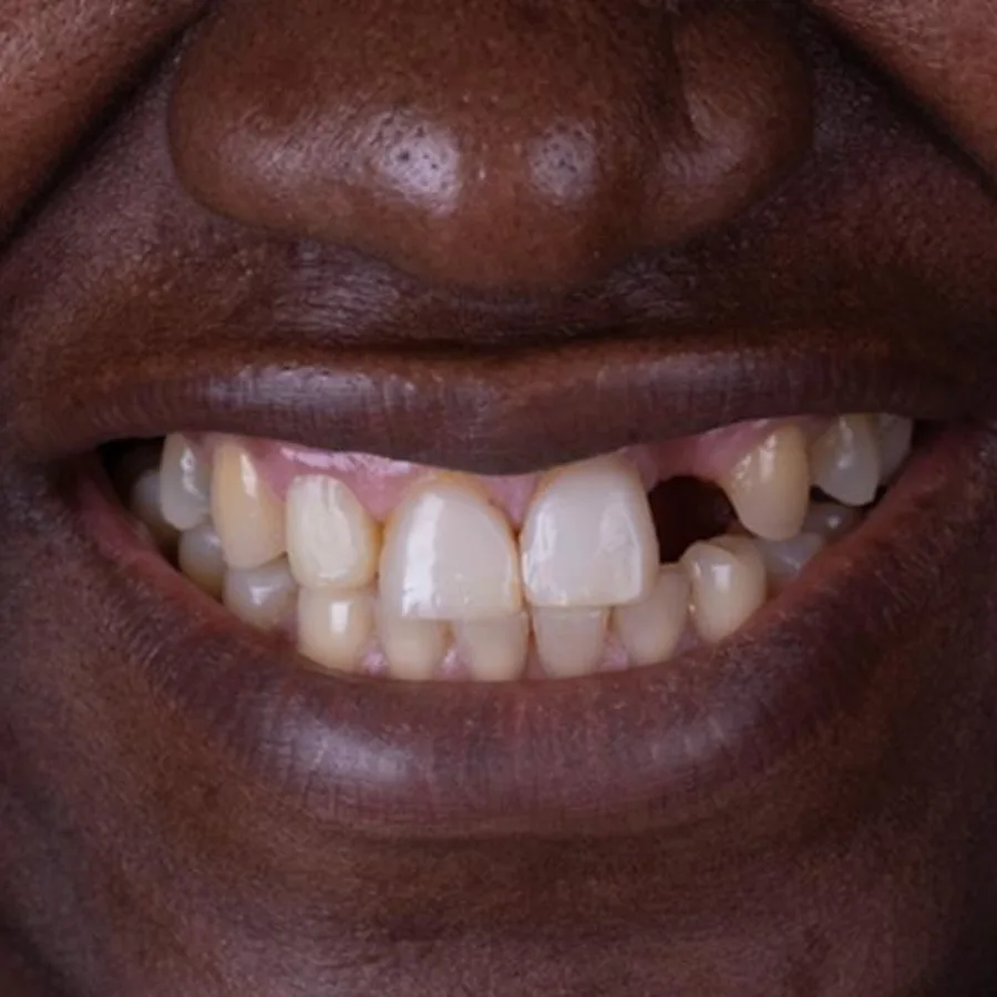 Before: full mouth All-on-6 implant restoration, 2024
