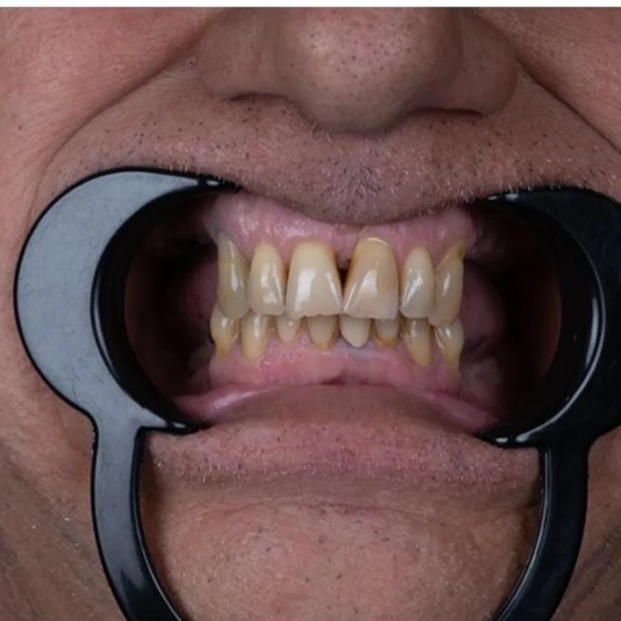 Before: full mouth All-on-6 implant restoration, 2025