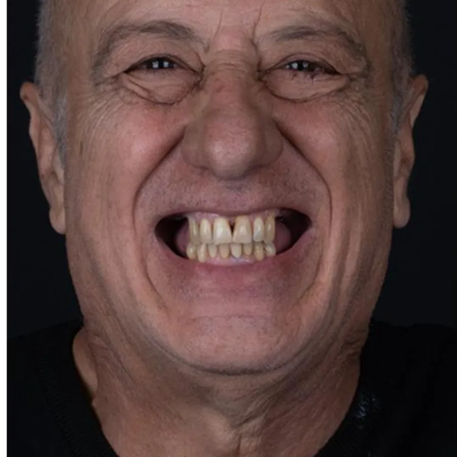 Before: full mouth All-on-6 implant restoration, 2026