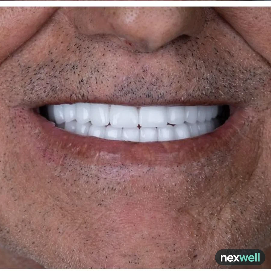 After: full mouth All-on-6 implant restoration, 2027