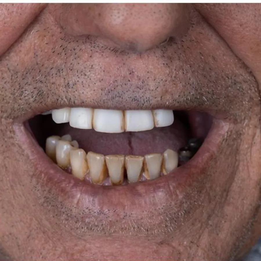 Before: full mouth All-on-6 implant restoration, 2027