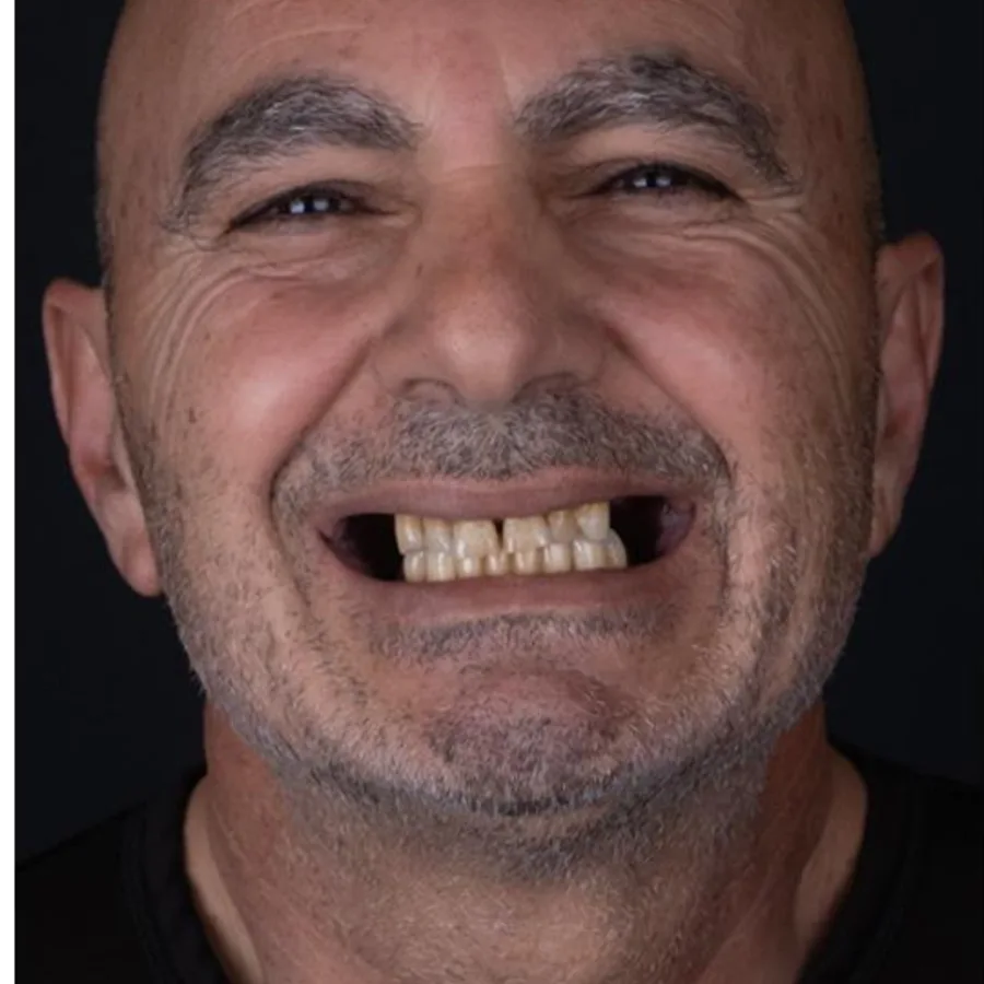 Before: full mouth All-on-6 implant restoration, 2028