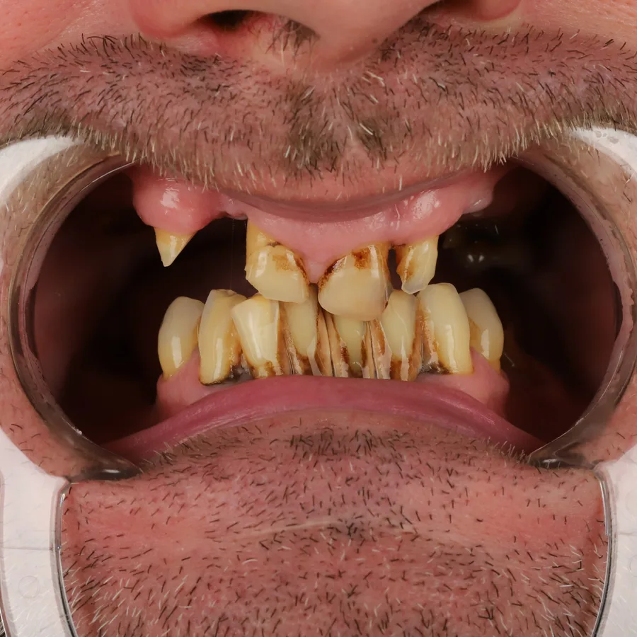 Before: full mouth All-on-6 implant restoration, 2029