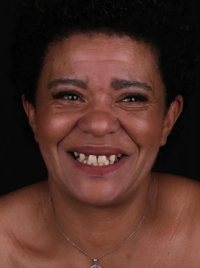 Dental patient 4215 before treatment at a NexWell contracted clinic