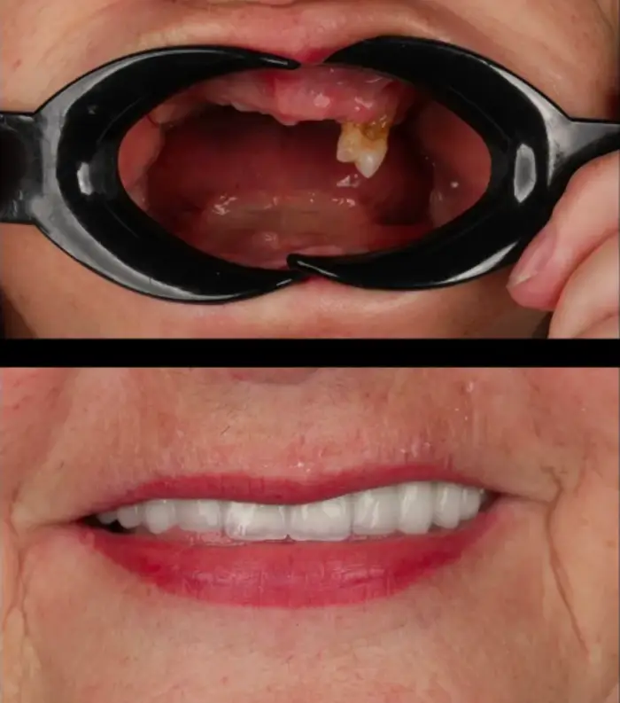 Before and after photos of a full-arch implant patient's smile