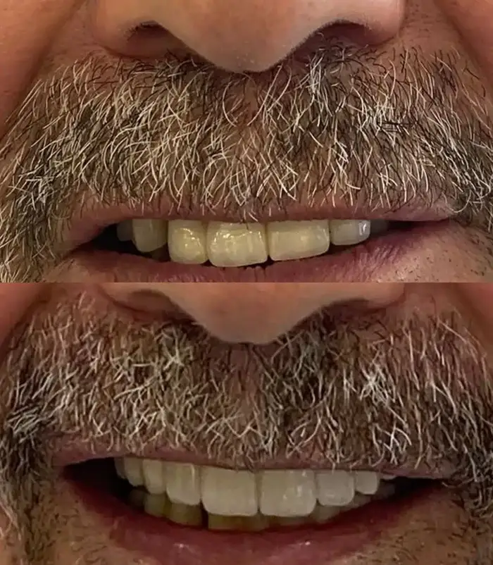 Before and after photos of a full-mouth implant patient's smile