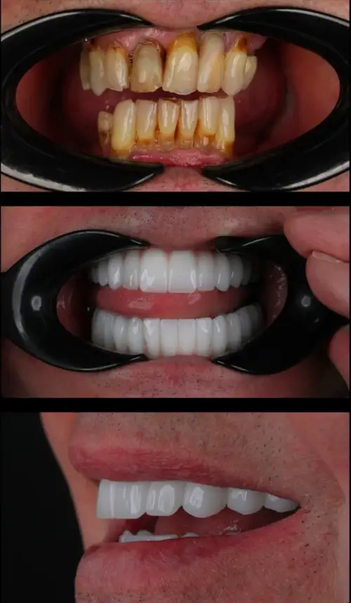 Before and after photos of a full-mouth implant patient's smile