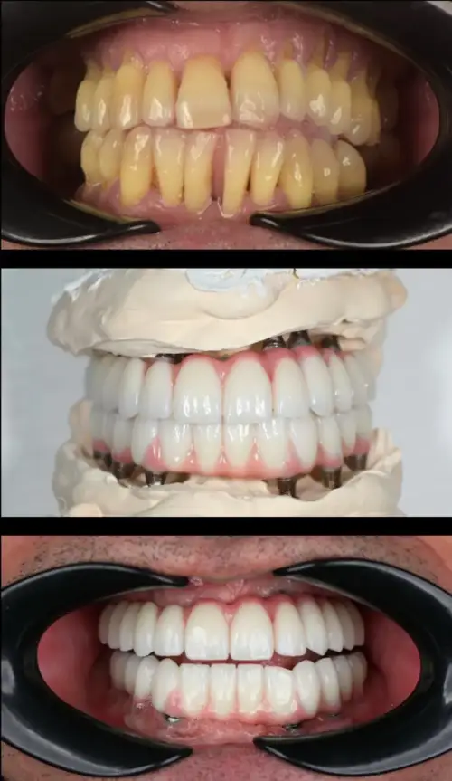 Before and after photos of a full-mouth implant patient's smile, including the implant abutments during treatment
