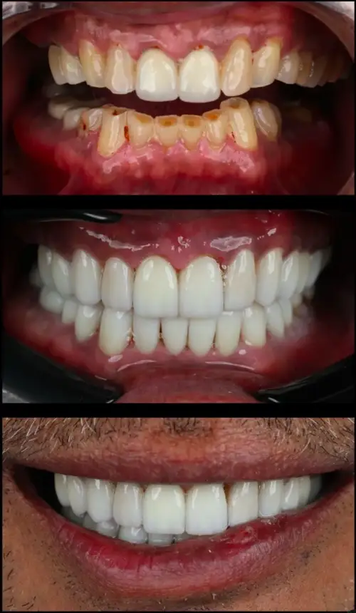Before and after photos of a full-mouth implant patient's smile