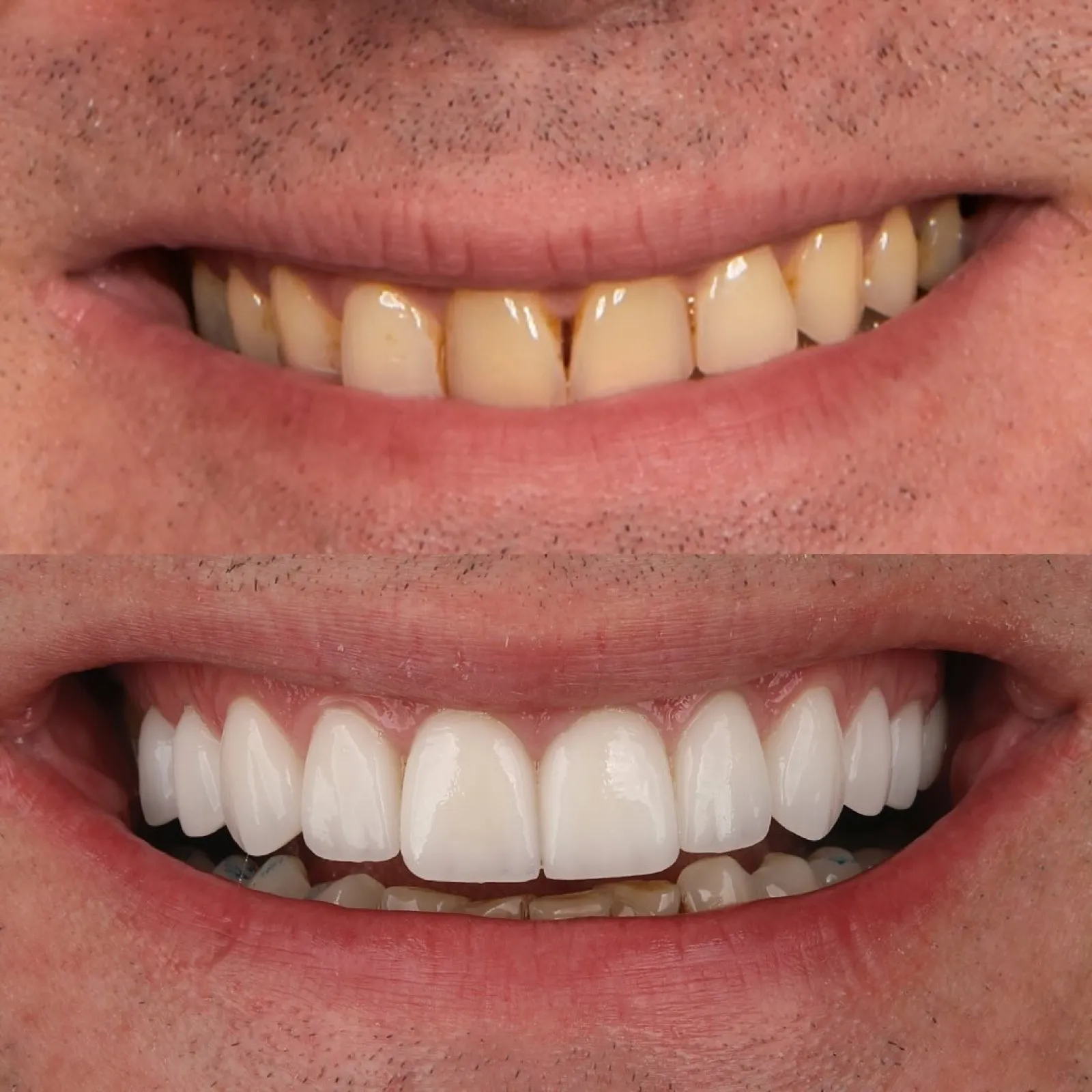 Laminate veneers and minimal preparation guide in Turkey