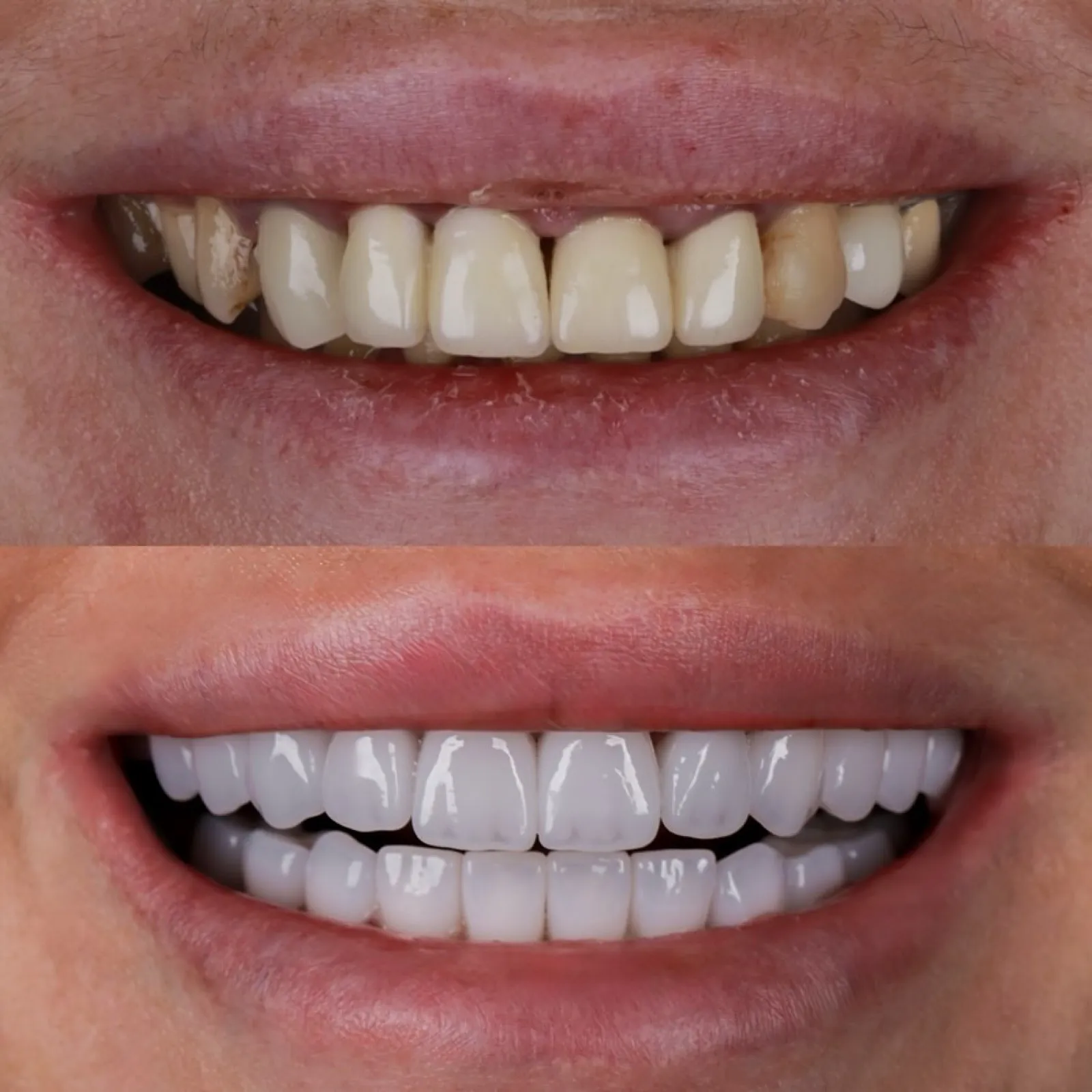 Smile makeover before and after result, close-up of upper and lower teeth transformation, Turkey dental clinic.