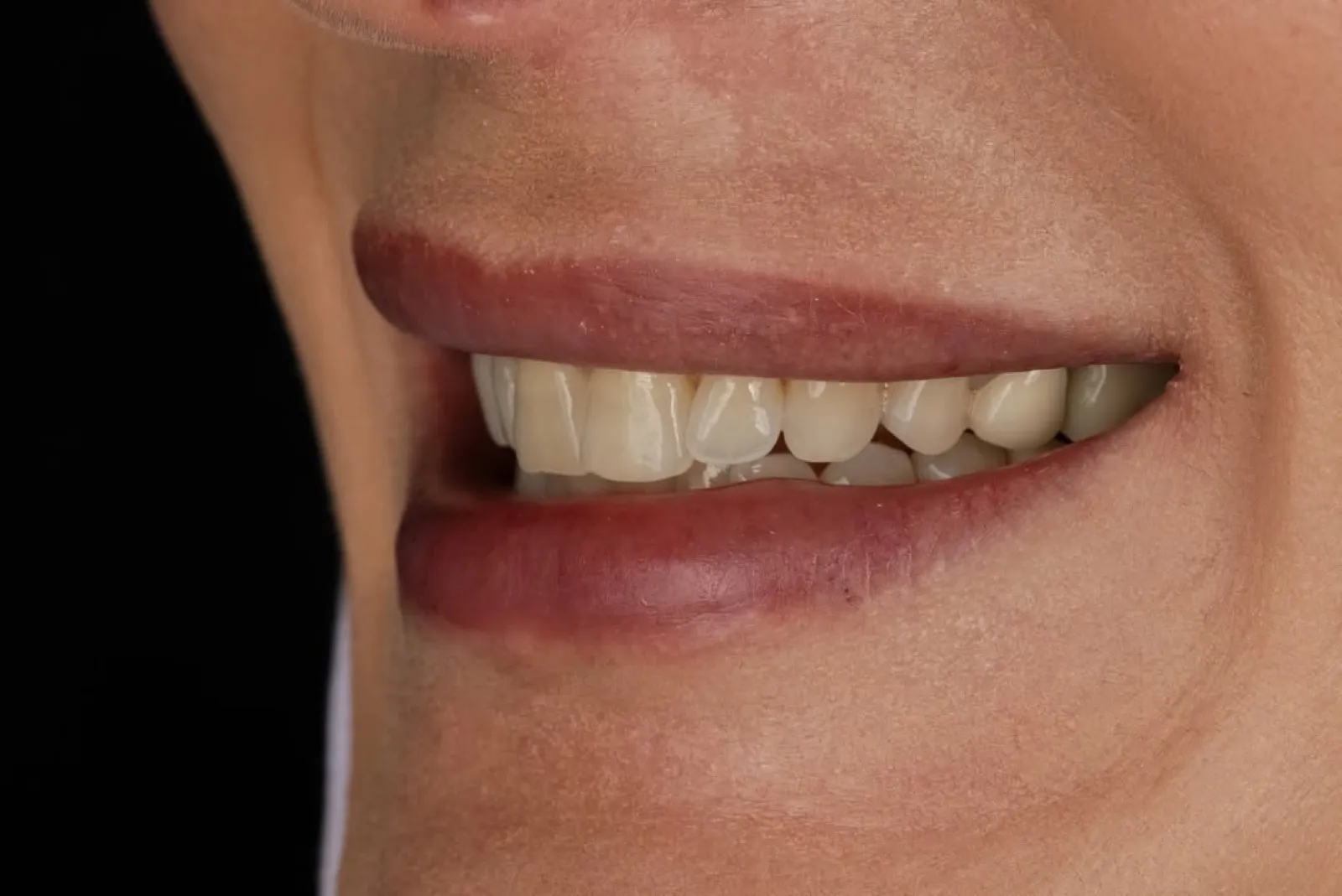 Smile makeover after result, close-up profile of white porcelain veneer smile, Turkey dental clinic.