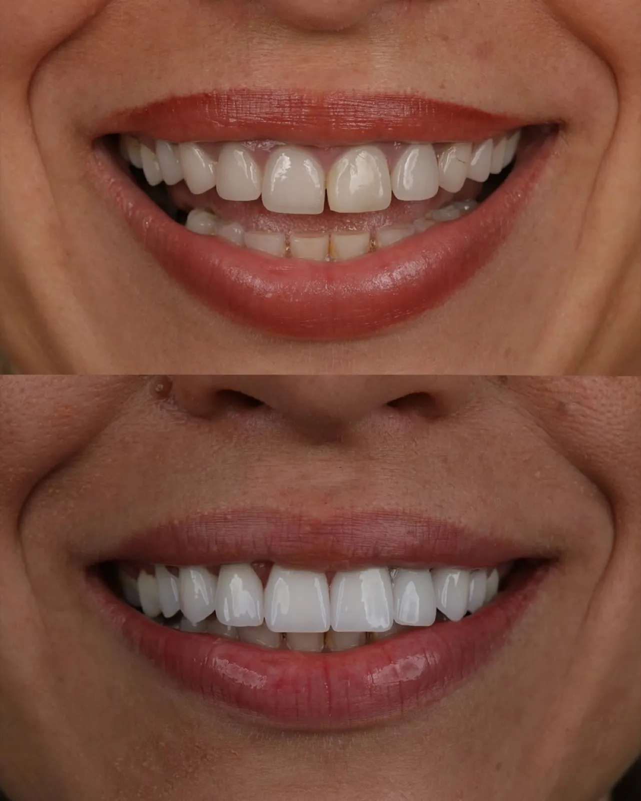Affordable Cosmetic Dentistry in Turkey