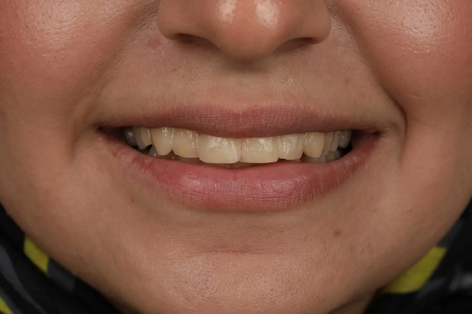 Before veneer treatment, close-up of discolored and unevenly shaped teeth, Turkey dental clinic.
