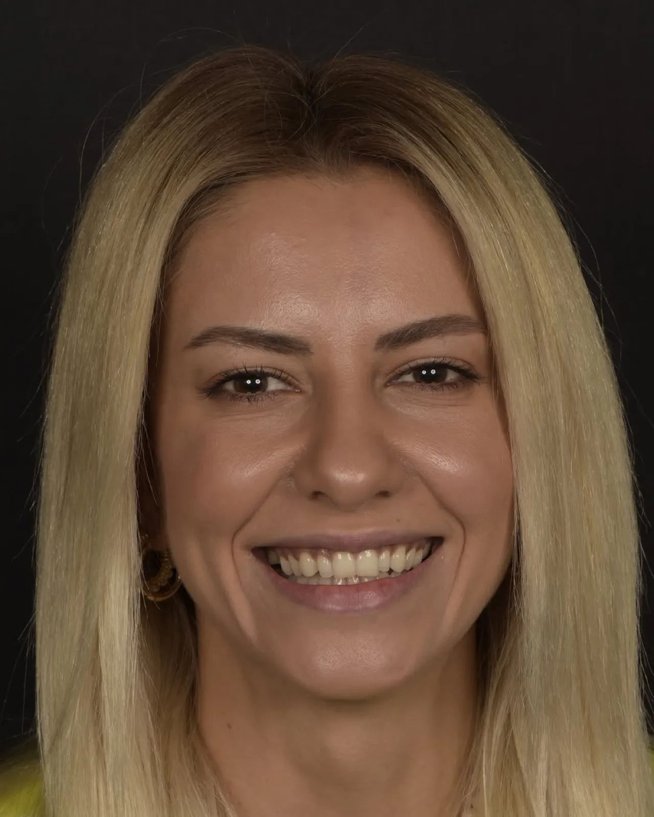Before veneer treatment, full face portrait of female patient with natural smile, Turkey dental clinic.