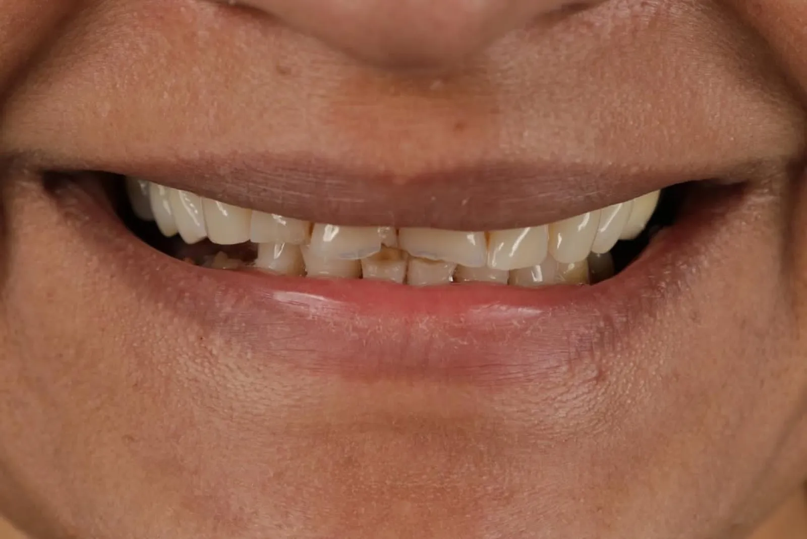 Before veneer treatment, close-up of worn and gapped teeth, Turkey dental clinic.