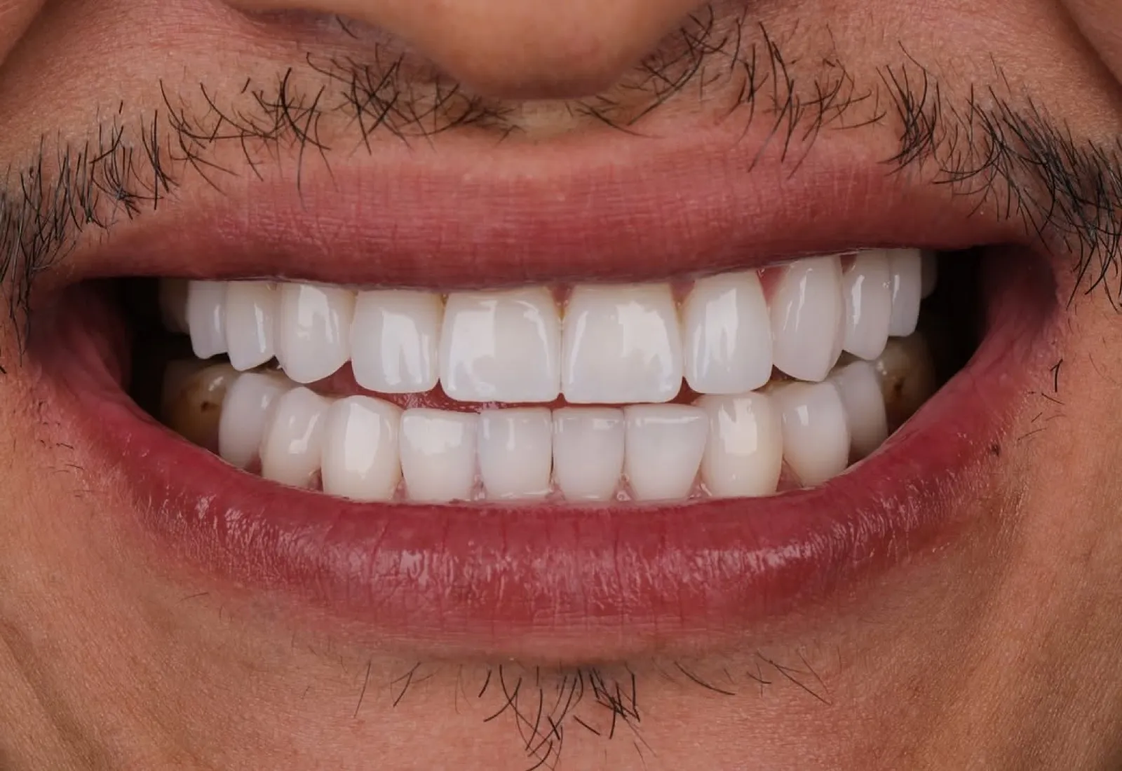 Porcelain veneers after result, close-up of white symmetrical smile, Turkey dental clinic.