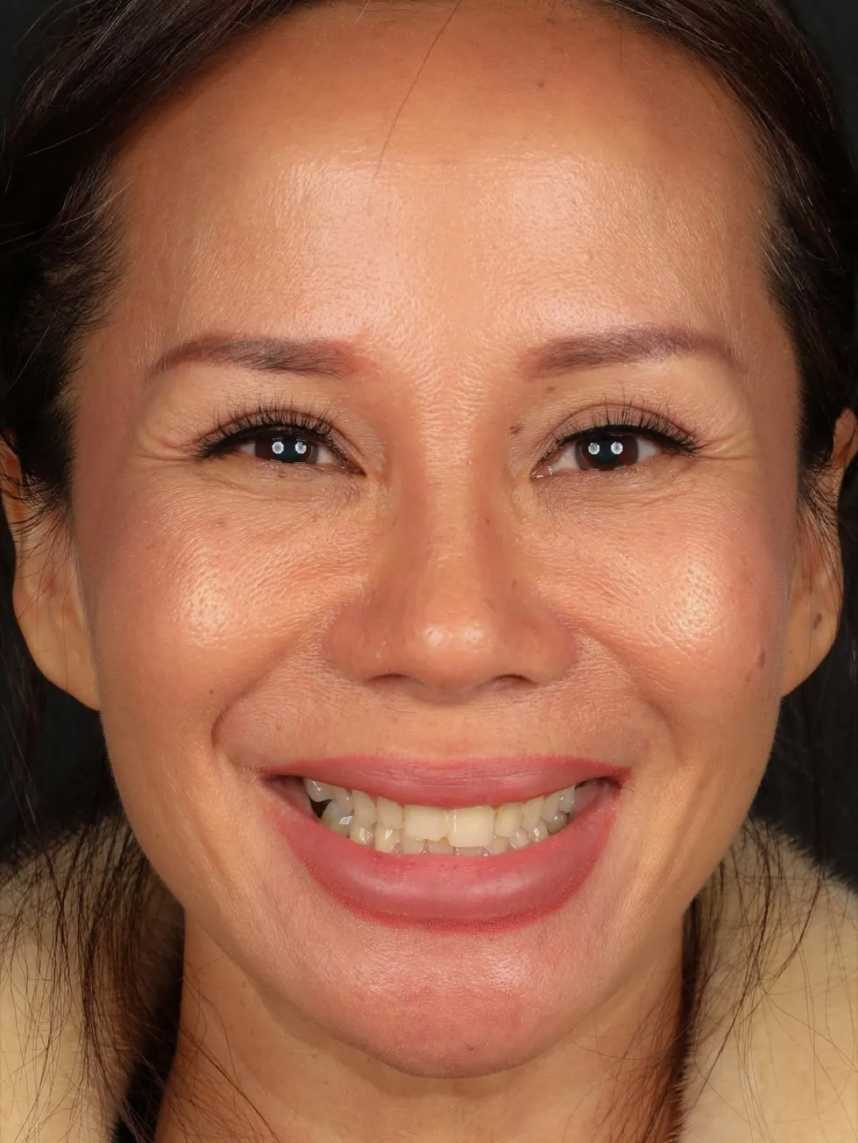 Before veneer treatment, full face portrait of mature female patient with natural smile, Turkey dental clinic.