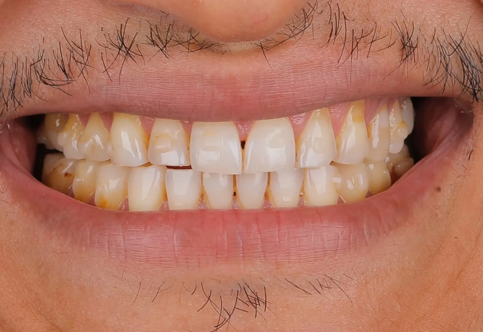 Porcelain veneers after result, full face portrait of mature female patient smiling, Turkey dental clinic.
