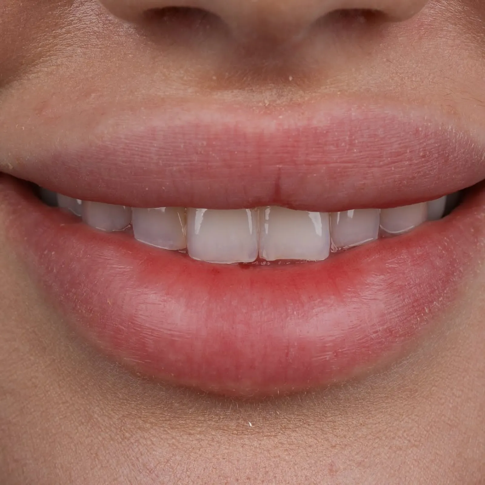 Before laminate veneer treatment, full face portrait of male patient wearing cap with natural smile, Turkey dental clinic.