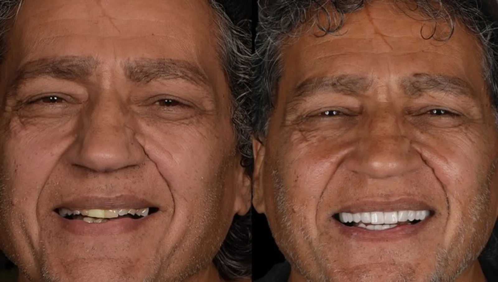 Before dental treatment, full face portrait of male patient with cap and worn teeth, Turkey dental clinic.