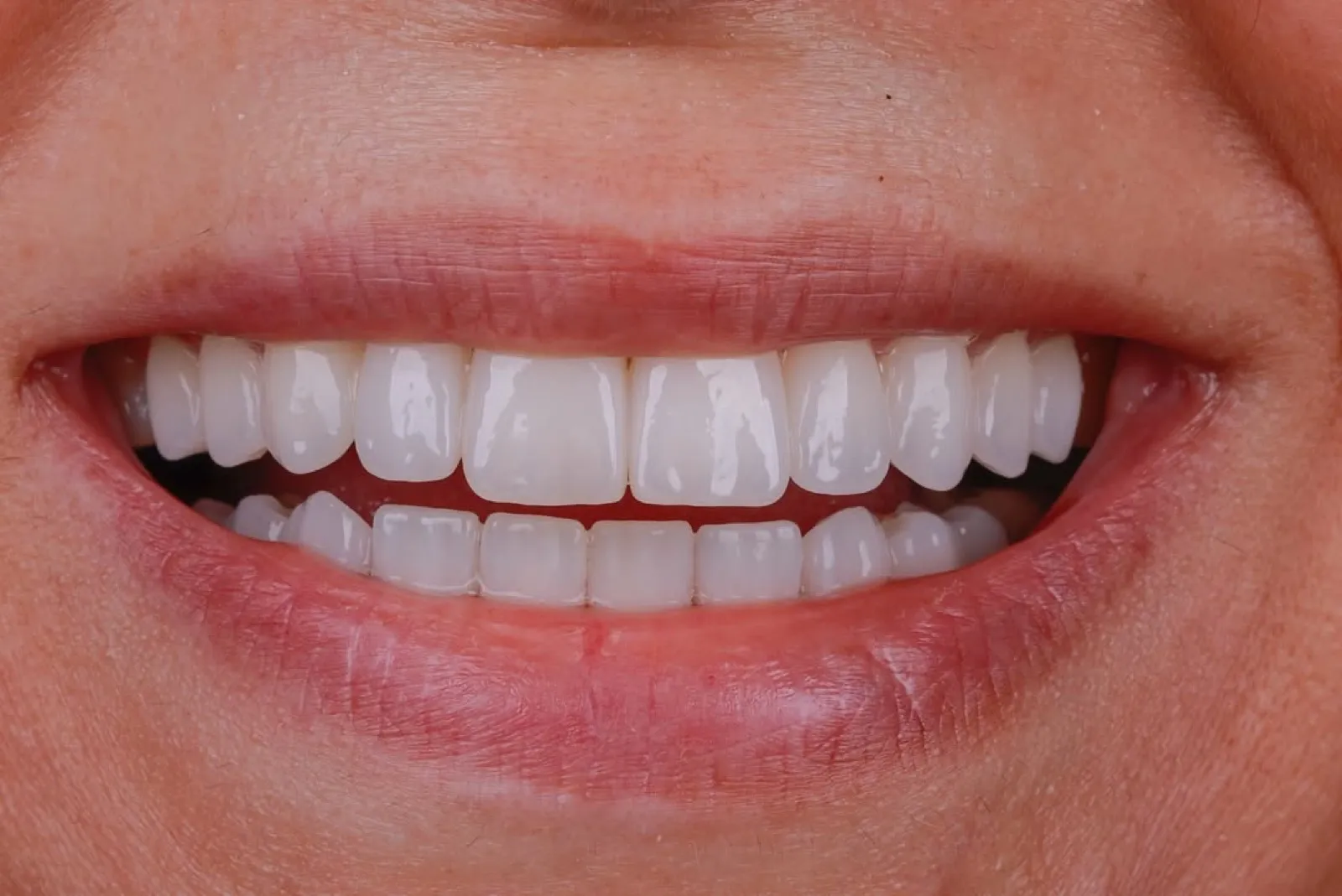 Porcelain veneers after result, close-up of white natural-looking smile, Turkey dental clinic.
