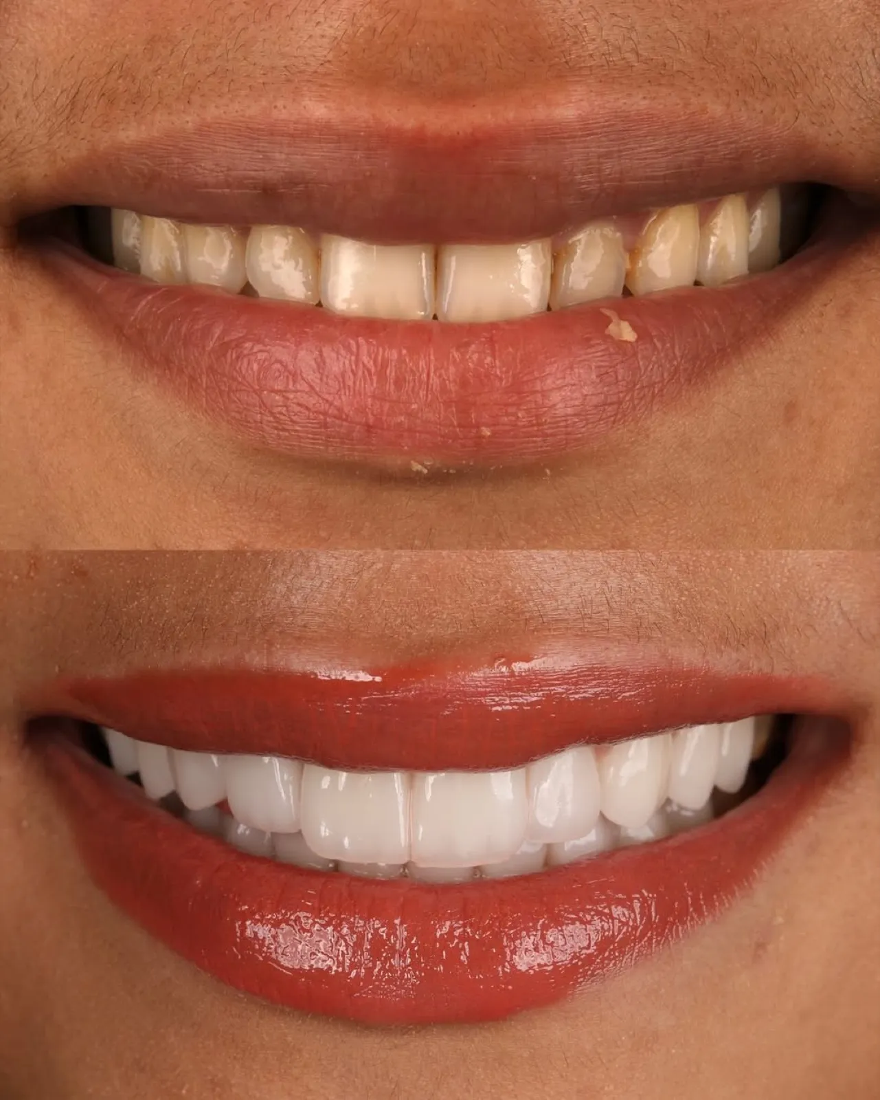 Laminate veneers before and after result, close-up comparison of yellowed versus white teeth, Turkey dental clinic.