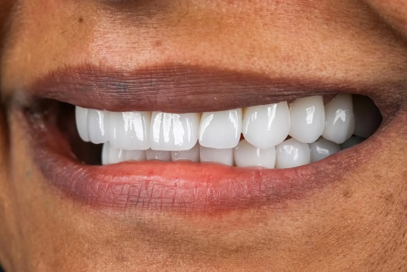 Porcelain veneers after result, close-up of straight white smile, Turkey dental clinic.