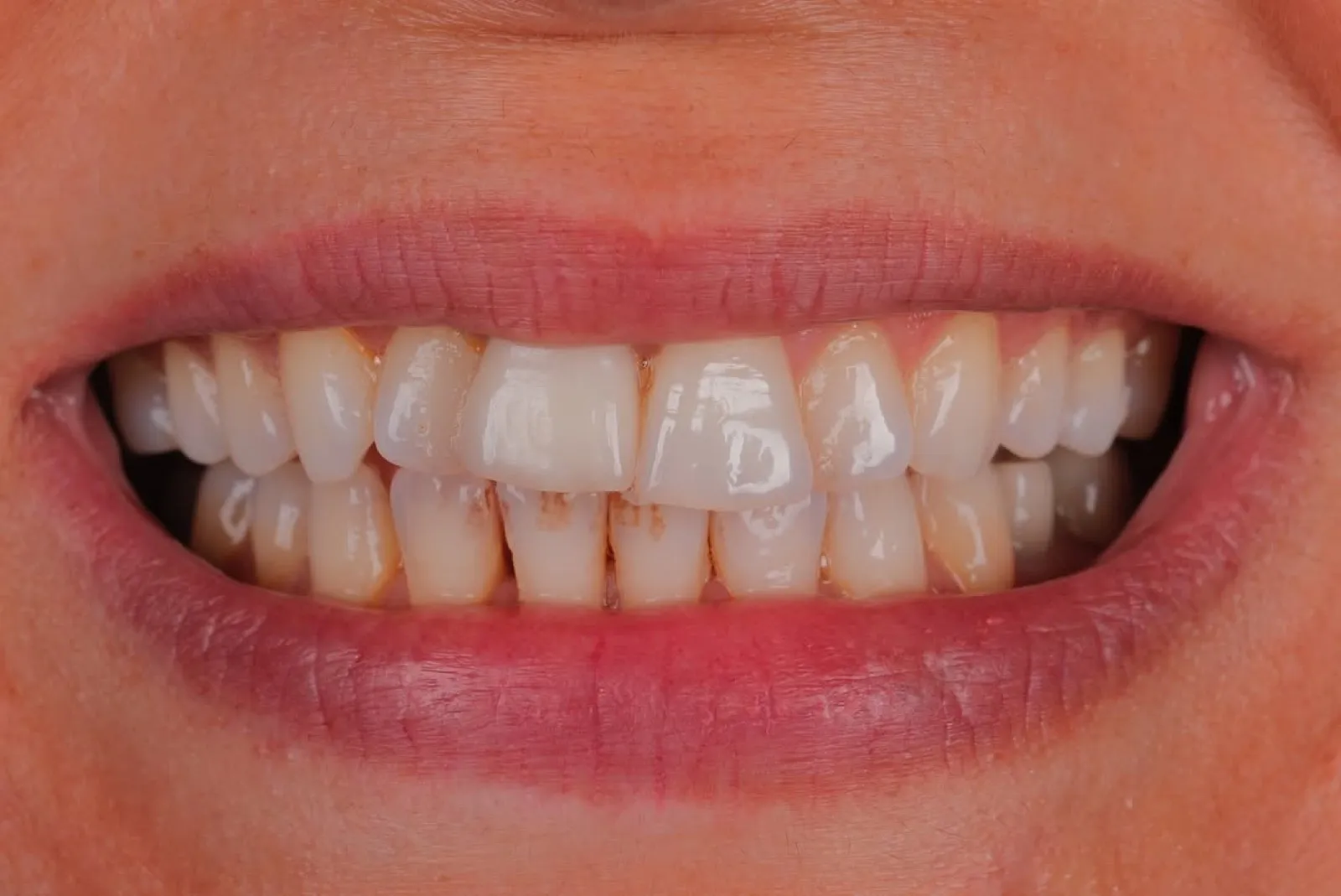 Before veneer treatment, close-up of worn and discolored teeth, Turkey dental clinic.