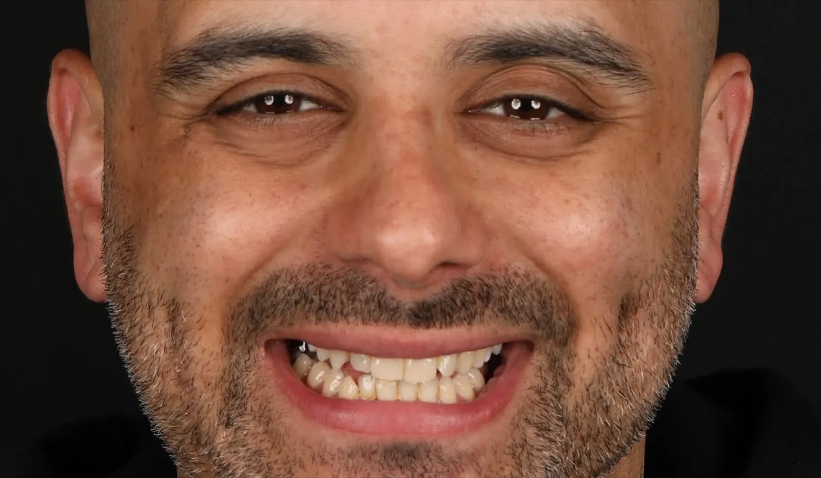 Before veneer treatment, full face close-up portrait of bald male patient with gapped teeth, Turkey dental clinic.