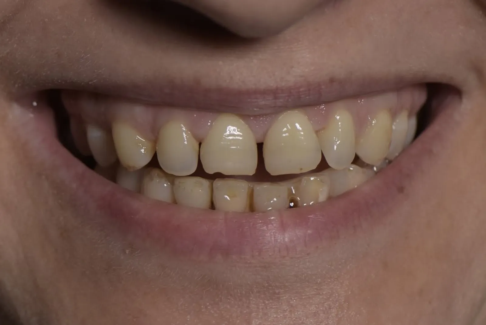 Before veneer treatment, close-up of worn and discolored front teeth, Turkey dental clinic.