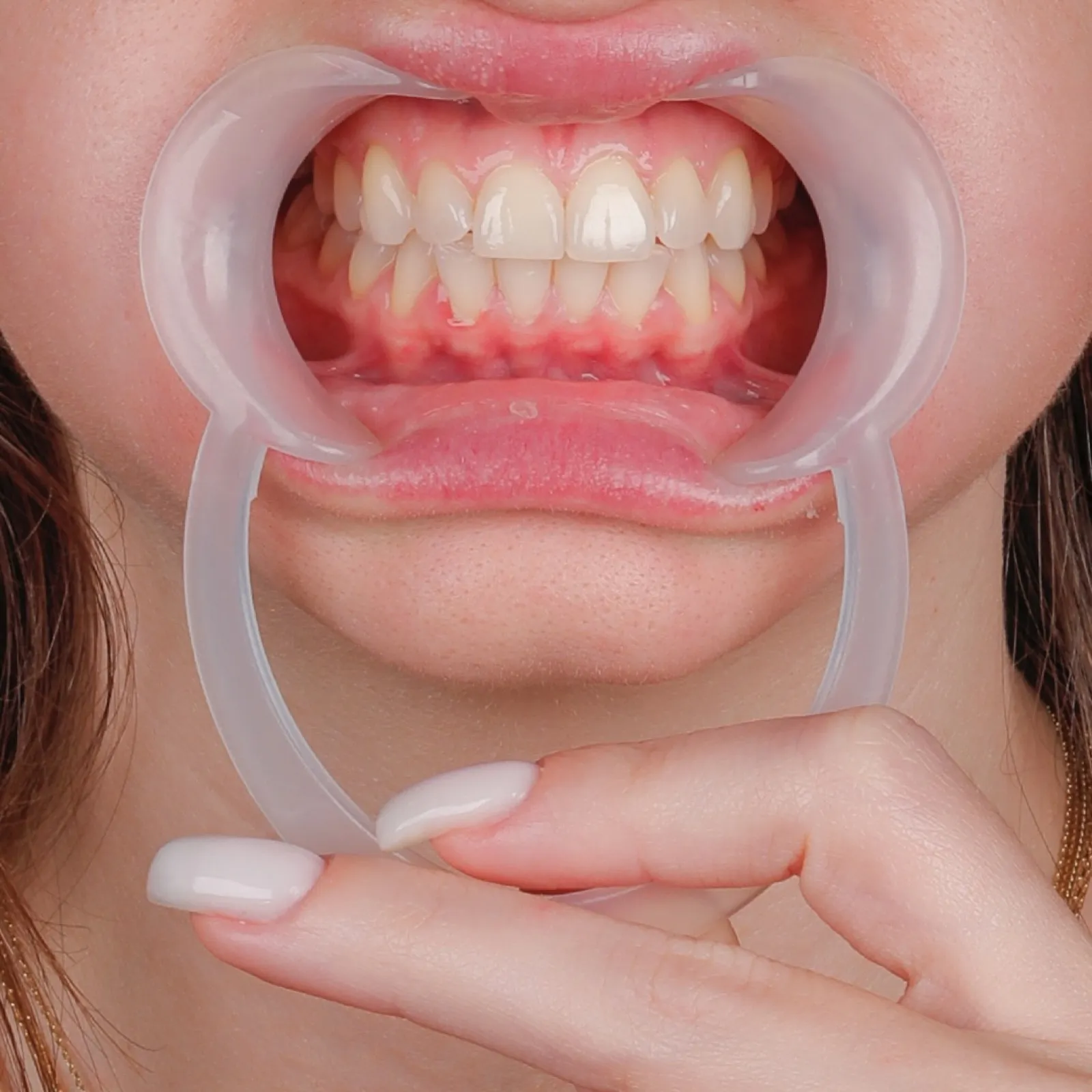 Before laminate veneer treatment, close-up of discolored teeth with dental retractor, Turkey dental clinic.