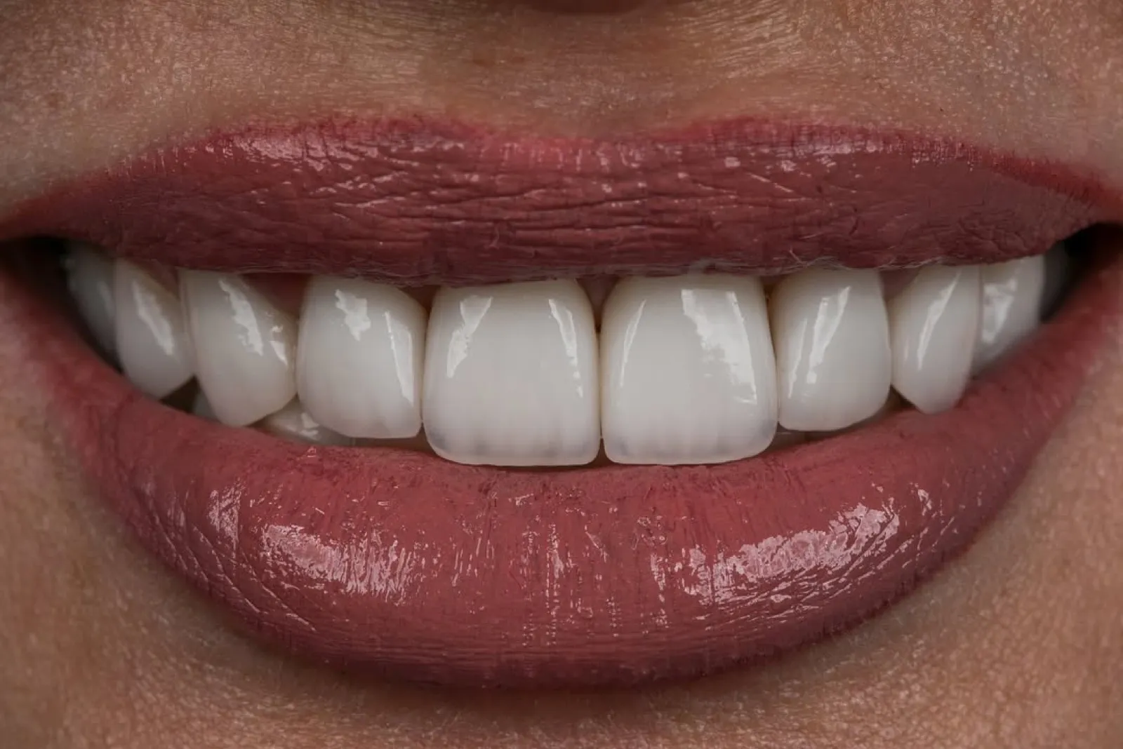 Porcelain veneers after result, close-up of white front teeth, Turkey dental clinic.