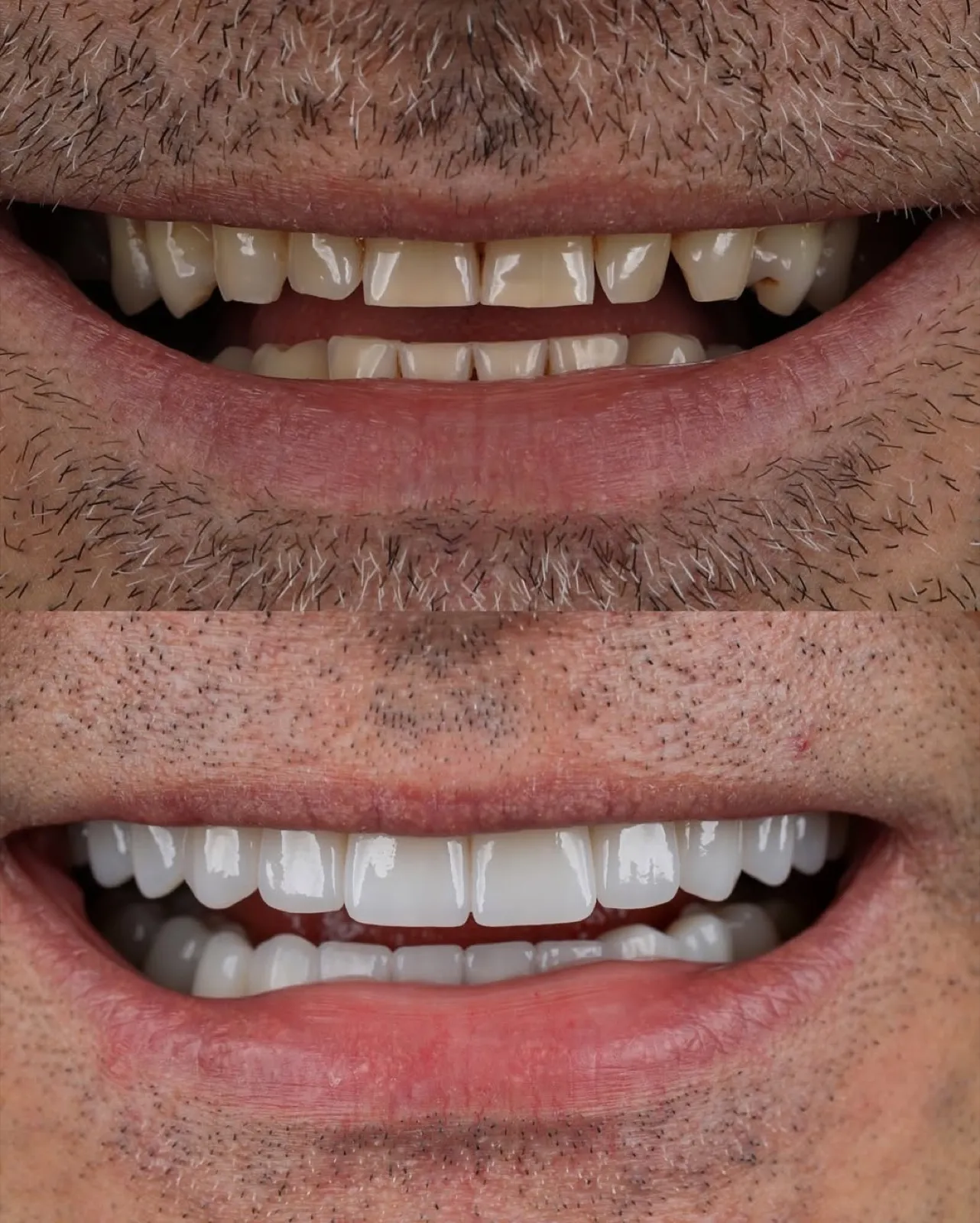 Before and after veneer treatment, close-up comparison of worn versus white porcelain teeth, Turkey dental clinic.