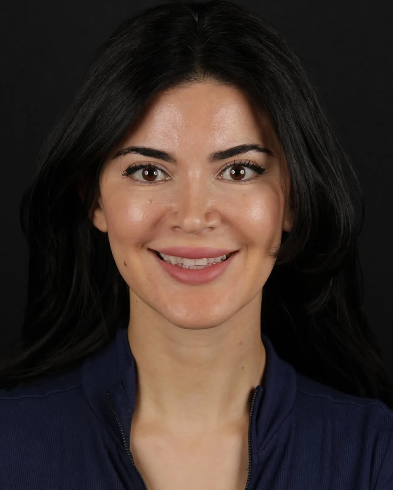Before laminate veneer treatment, full face portrait of female patient with natural smile, Turkey dental clinic.