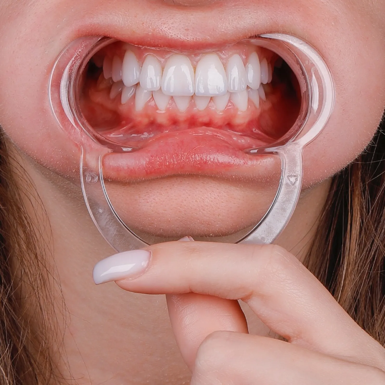 Porcelain laminate veneers after result, close-up of white teeth with dental retractor, Turkey dental clinic.