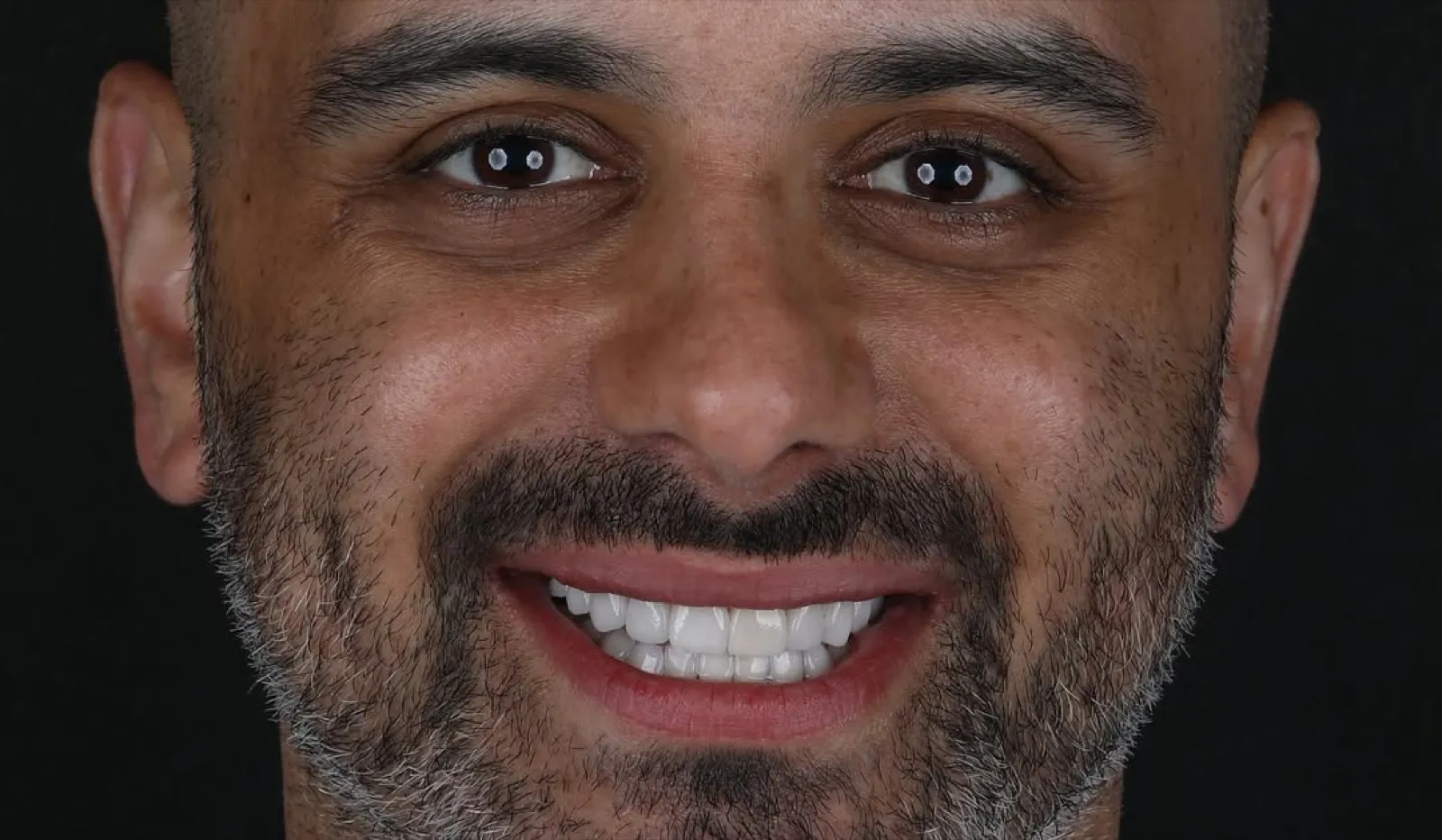 Porcelain veneers after result, full face portrait of male patient with beard smiling, Turkey dental clinic.
