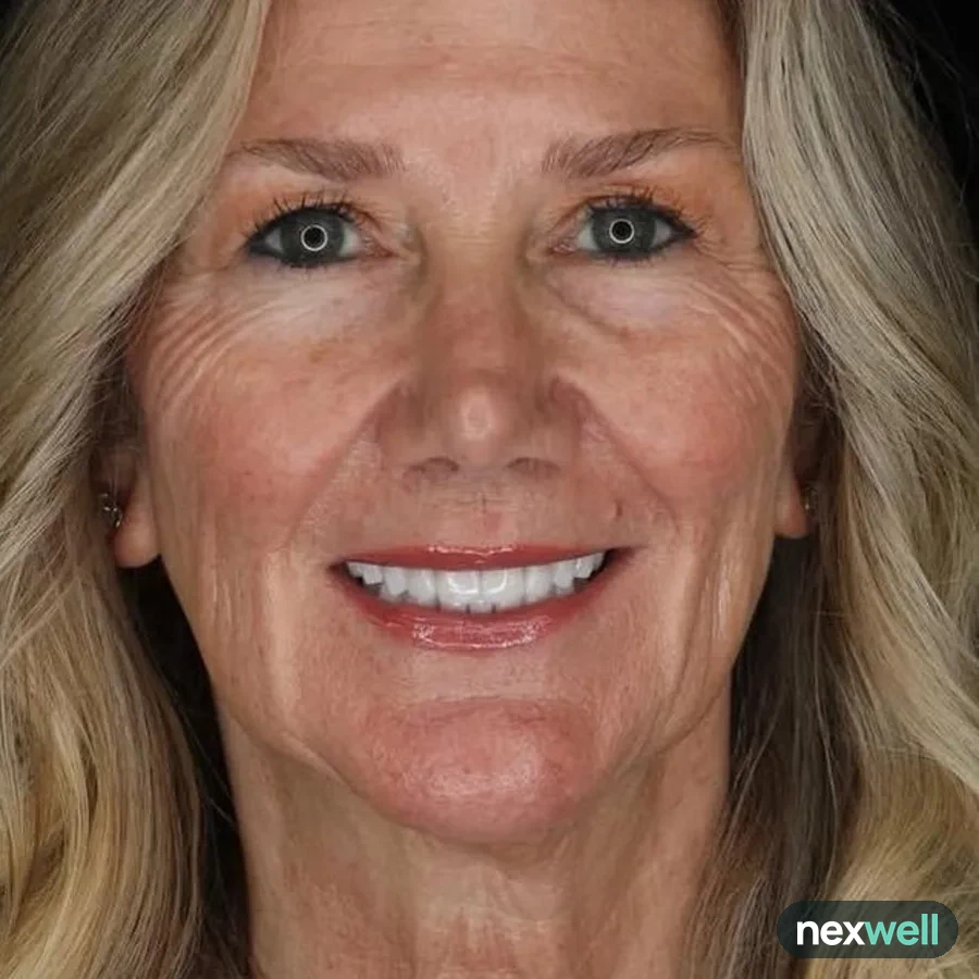 After: veneer and zirconia smile restoration, 3002