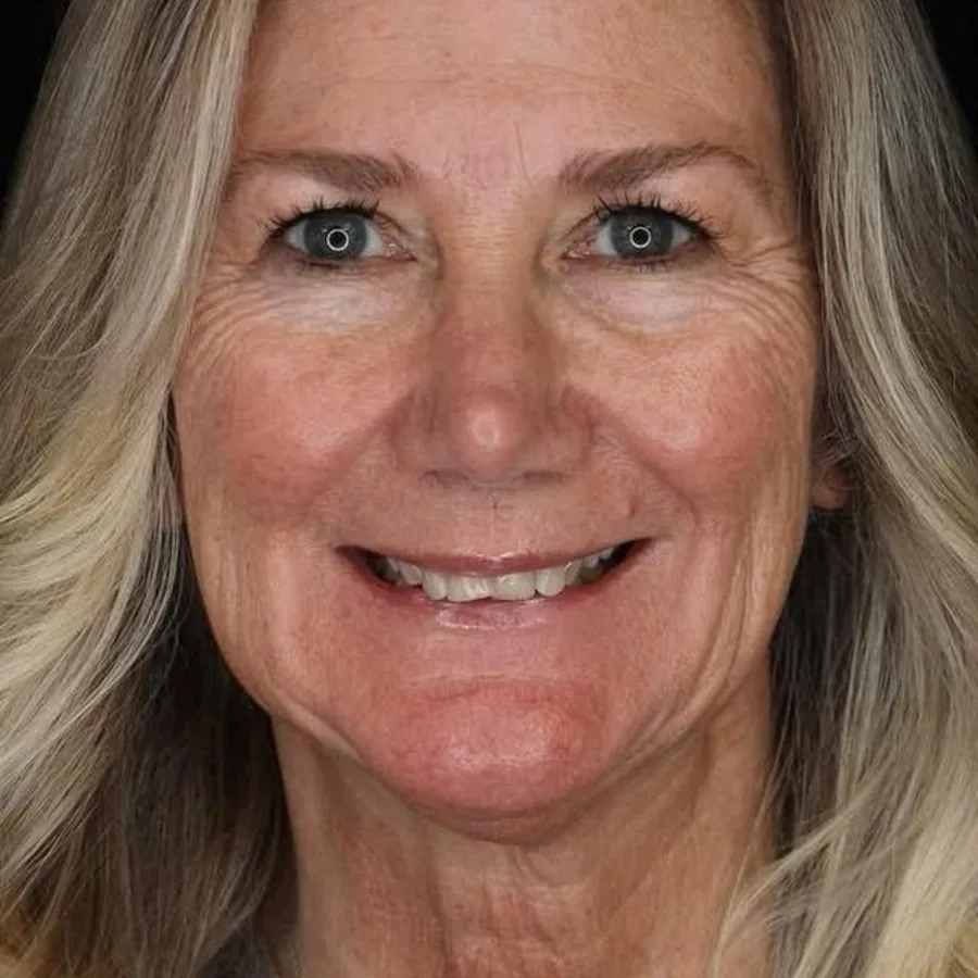 Before: veneer and zirconia smile restoration, 3002