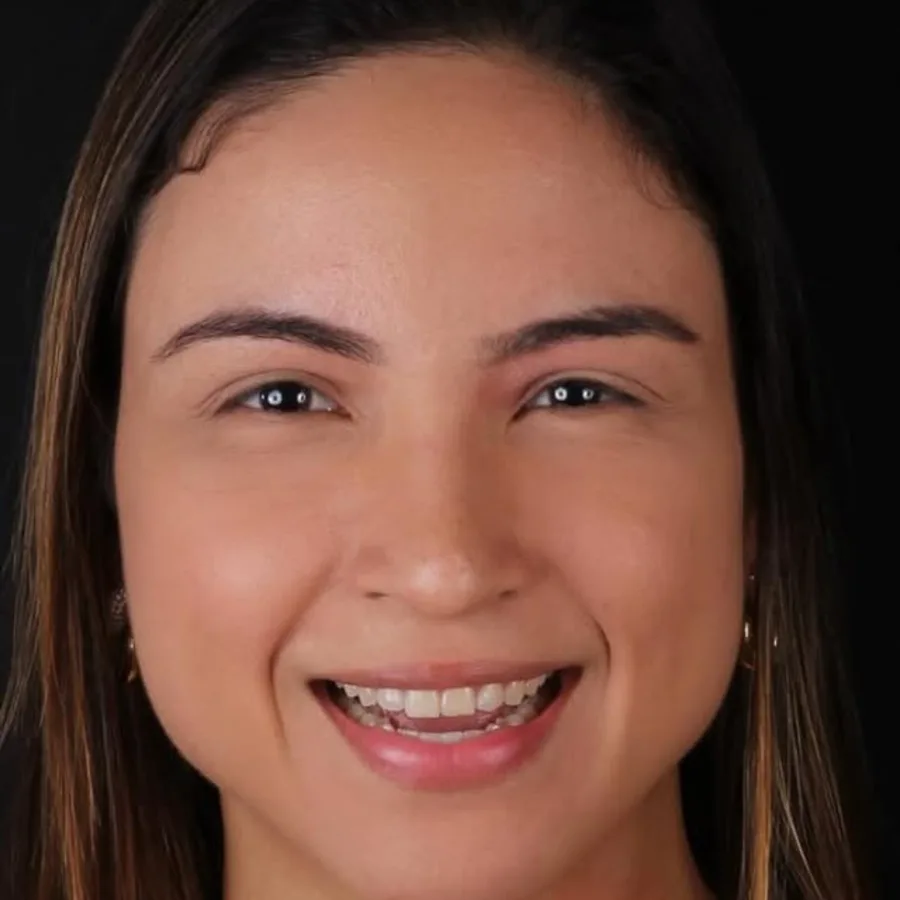 Before: veneer and zirconia smile restoration, 3004