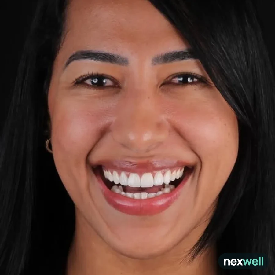 After: veneer and zirconia smile restoration, 3005