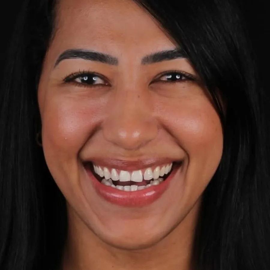 Before: veneer and zirconia smile restoration, 3005