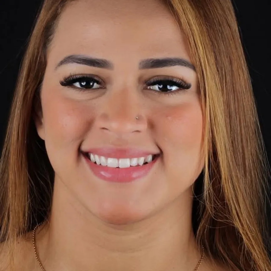 Before: veneer and zirconia smile restoration, 3007