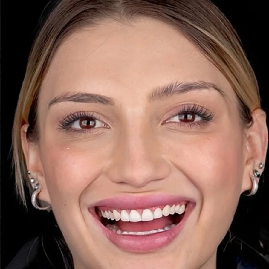 Before: veneer and zirconia smile restoration, 3008