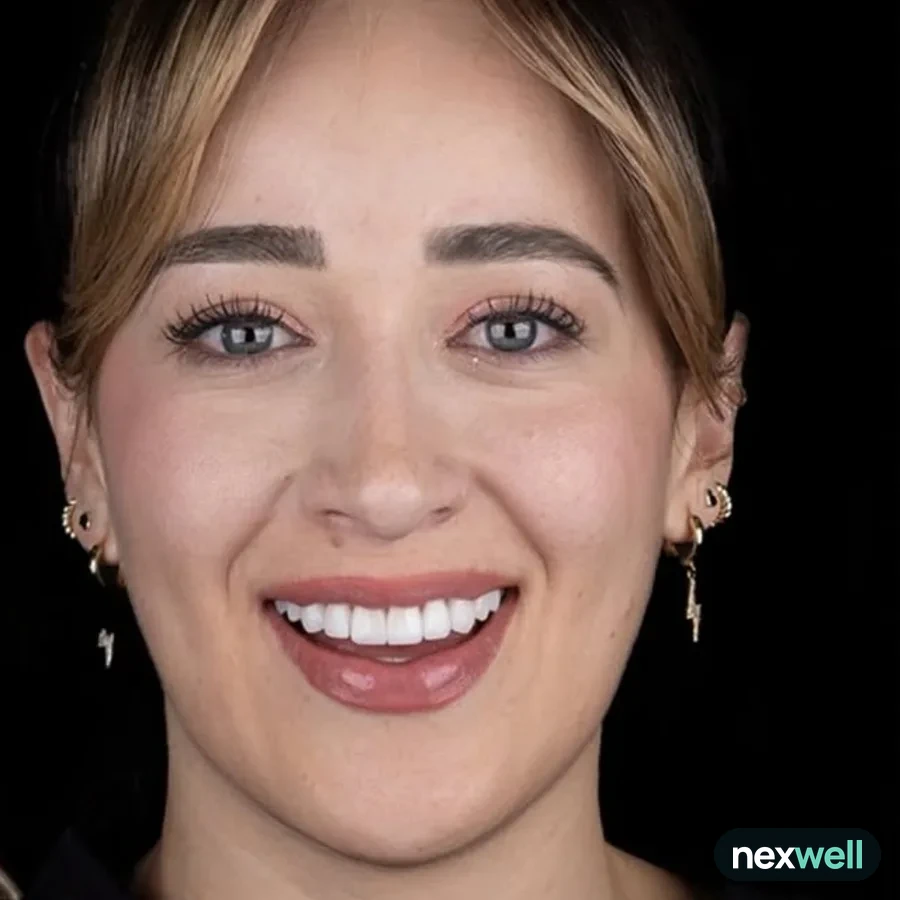 After: veneer and zirconia smile restoration, 3009