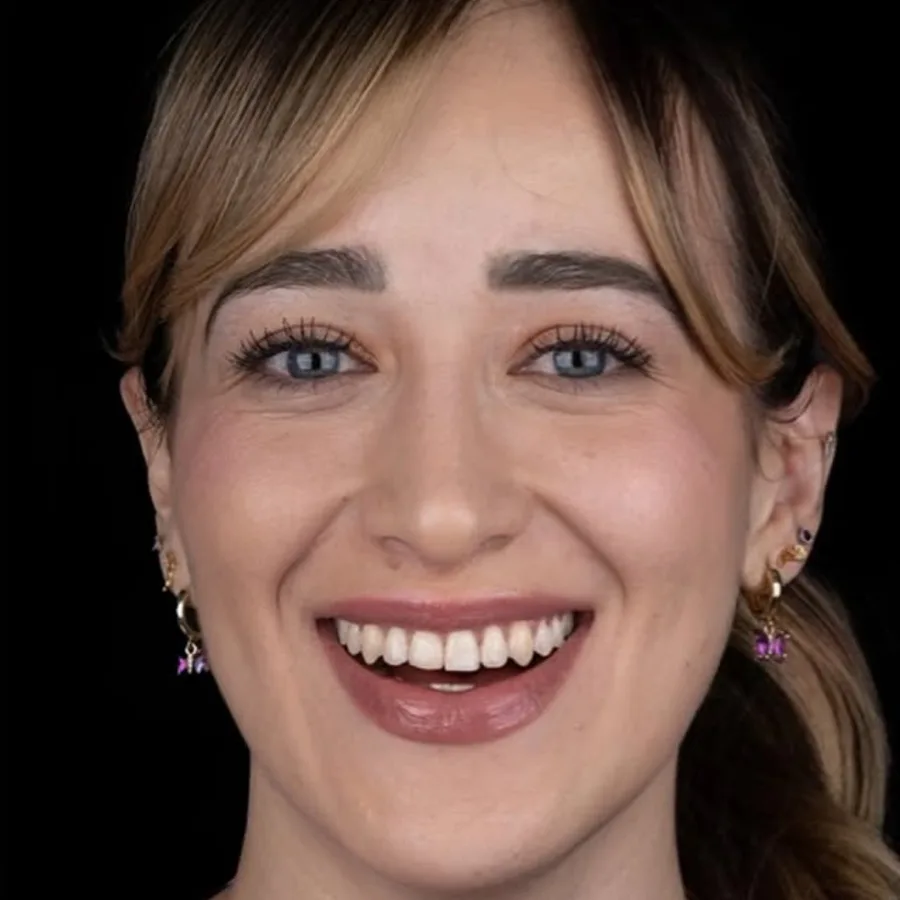 Before: veneer and zirconia smile restoration, 3009